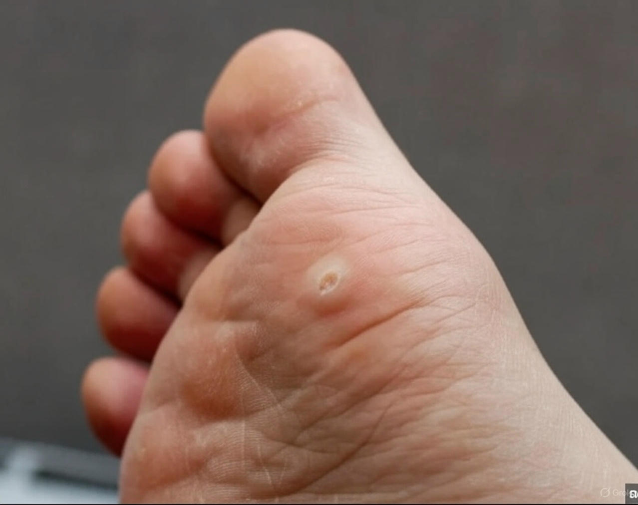 Wart treatment procedure