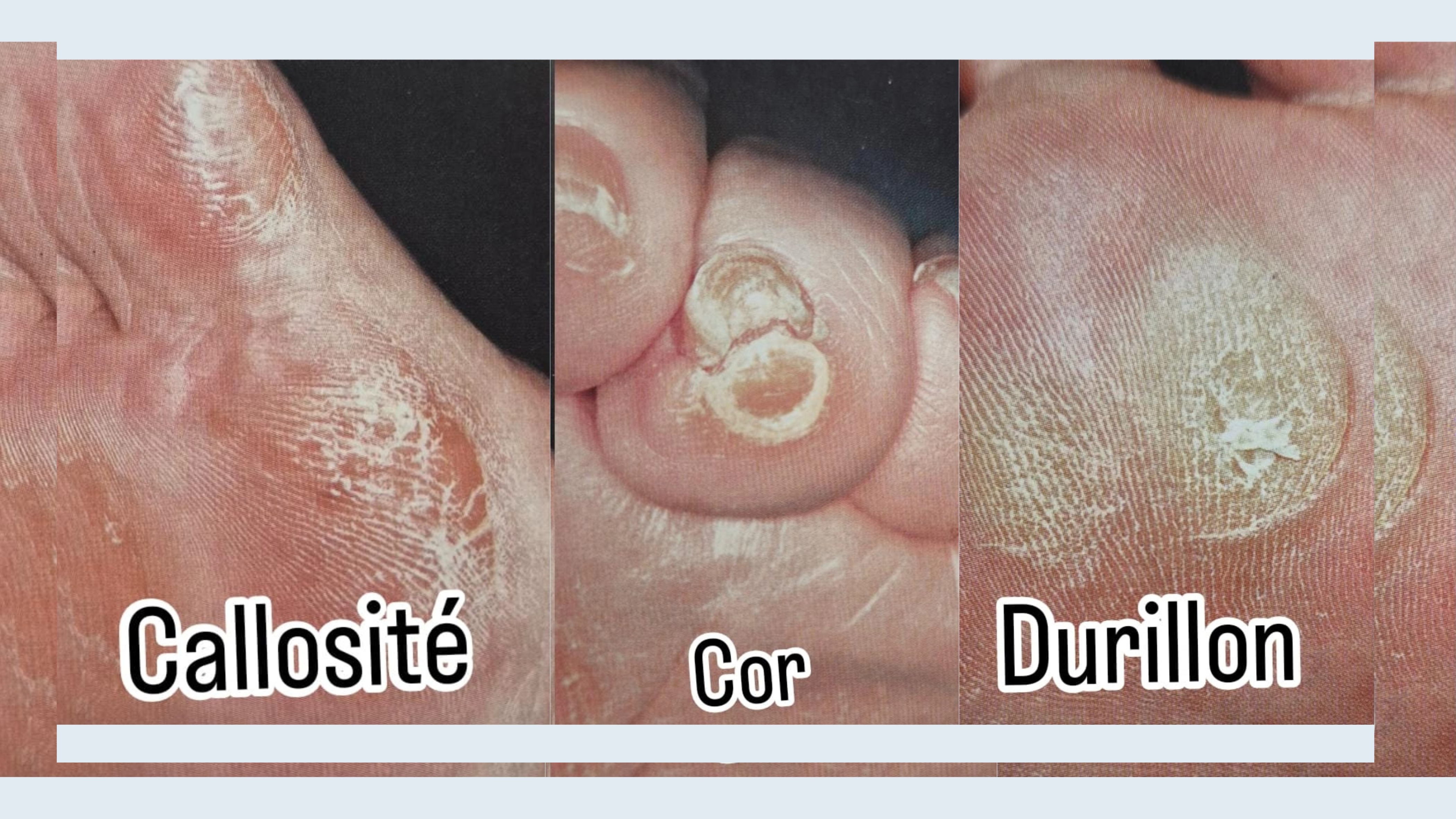 Complete foot care treatment